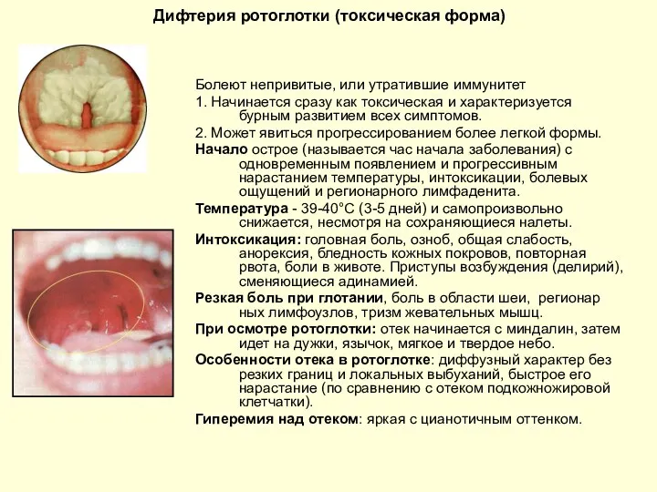 Дифтерия ротоглотки (токсическая форма) Болеют непривитые, или утратившие иммунитет 1.