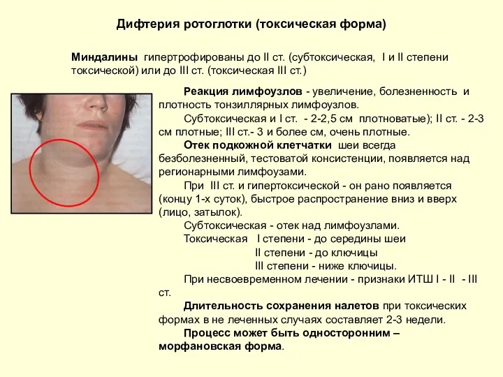 Дифтерия ротоглотки (токсическая форма) Миндалины гипертрофированы до II ст. (субтоксическая,