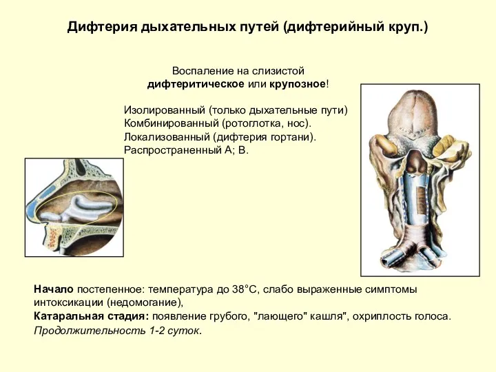 Дифтерия дыхательных путей (дифтерийный круп.) Воспаление на слизистой дифтеритическое или