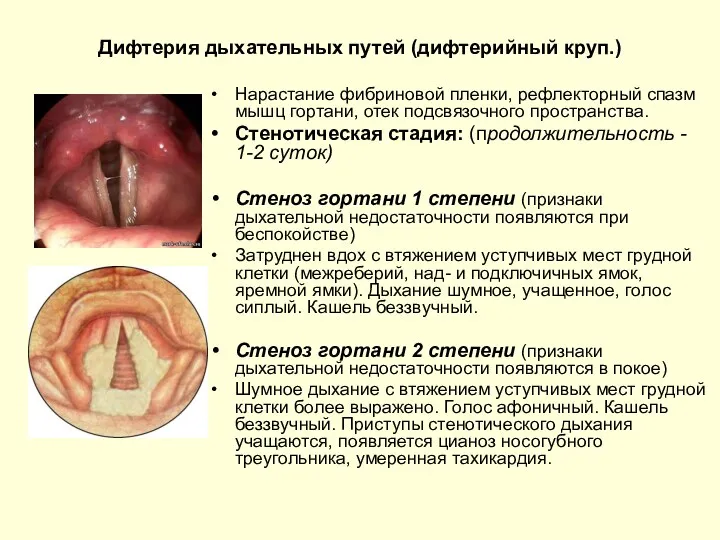 Дифтерия дыхательных путей (дифтерийный круп.) Нарастание фибриновой пленки, рефлекторный спазм