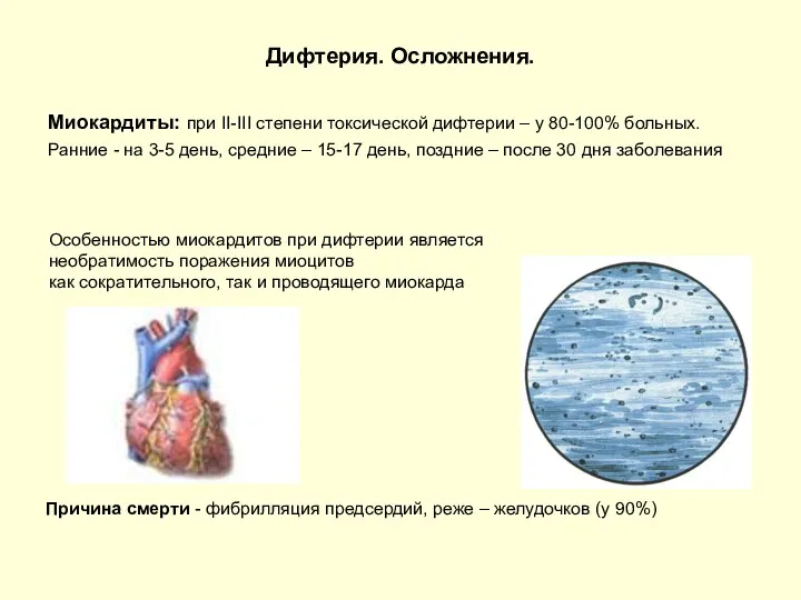 Дифтерия. Осложнения. Миокардиты: при II-III степени токсической дифтерии – у