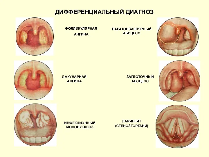 ДИФФЕРЕНЦИАЛЬНЫЙ ДИАГНОЗ ФОЛЛИКУЛЯРНАЯ АНГИНА ПАРАТОНЗИЛЛЯРНЫЙ АБСЦЕСС ЛАКУНАРНАЯ АНГИНА ЗАГЛОТОЧНЫЙ АБСЦЕСС ИНФЕКЦИОННЫЙ МОНОНУКЛЕОЗ