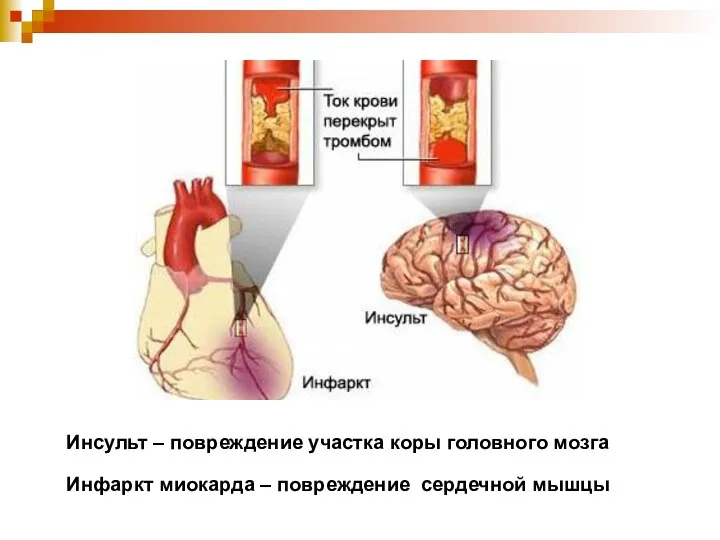 Инсульт – повреждение участка коры головного мозга Инфаркт миокарда – повреждение сердечной мышцы