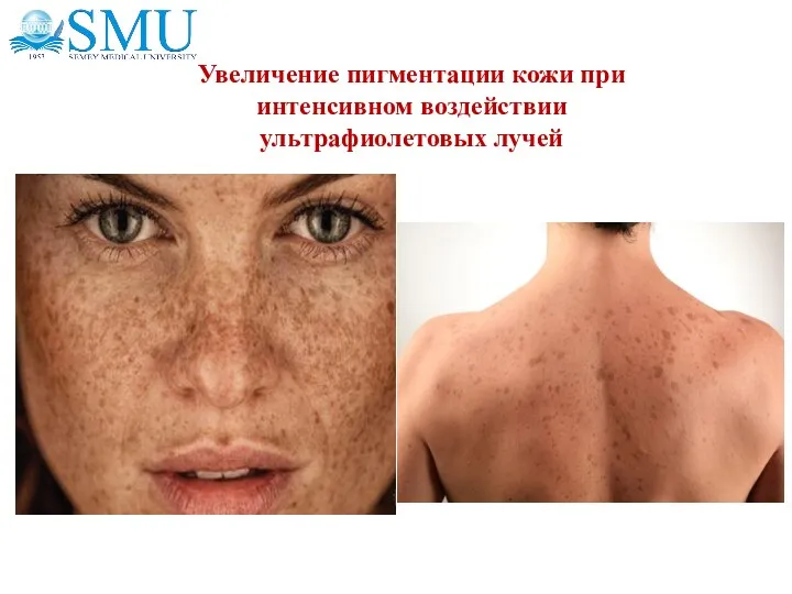 Увеличение пигментации кожи при интенсивном воздействии ультрафиолетовых лучей