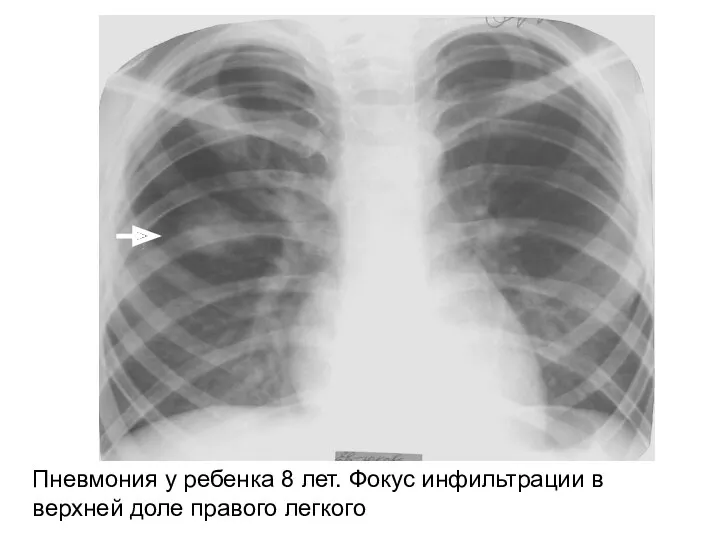 Пневмония у ребенка 8 лет. Фокус инфильтрации в верхней доле правого легкого
