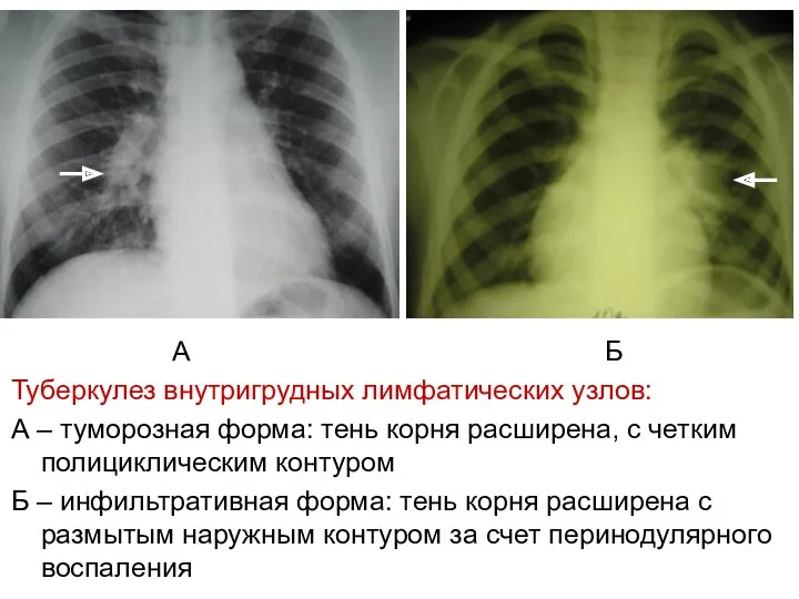 А Б Туберкулез внутригрудных лимфатических узлов: А – туморозная форма: