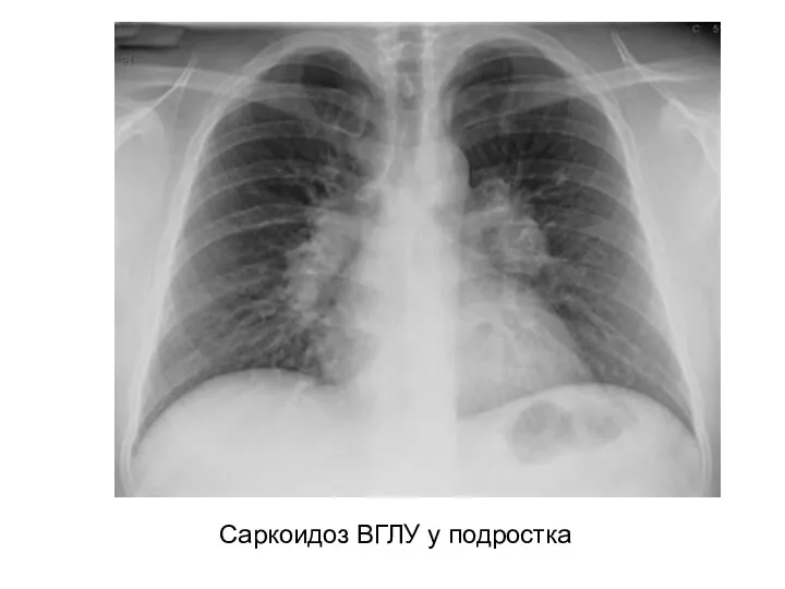 Саркоидоз ВГЛУ у подростка