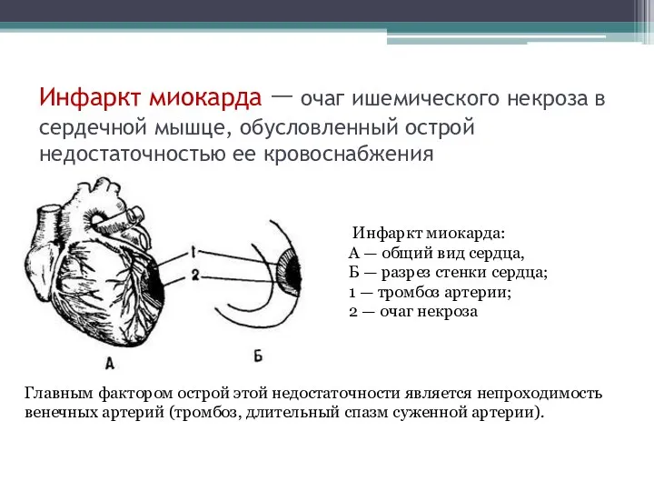 Инфаркт миокарда — очаг ишемического некроза в сердечной мышце, обусловленный