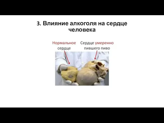 3. Влияние алкоголя на сердце человека