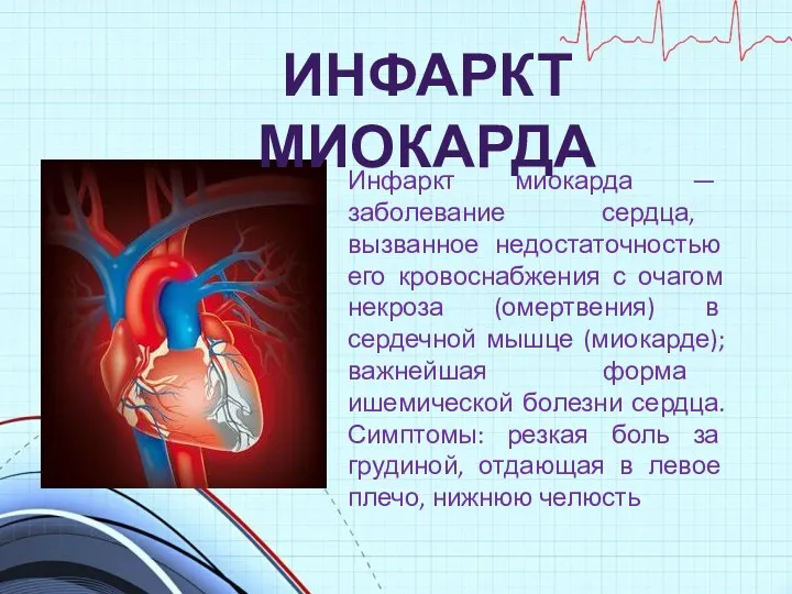 Инфаркт миокарда — заболевание сердца, вызванное недостаточностью его кровоснабжения с
