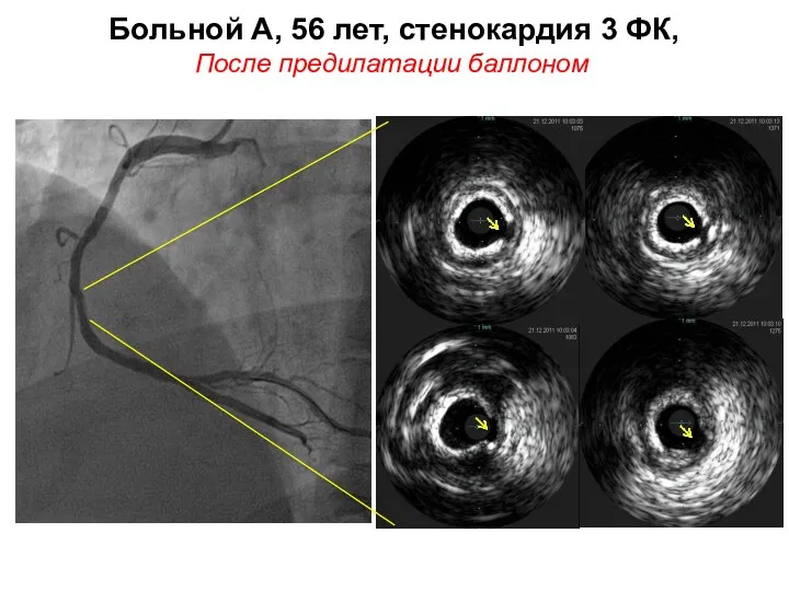 Больной А, 56 лет, стенокардия 3 ФК, После предилатации баллоном