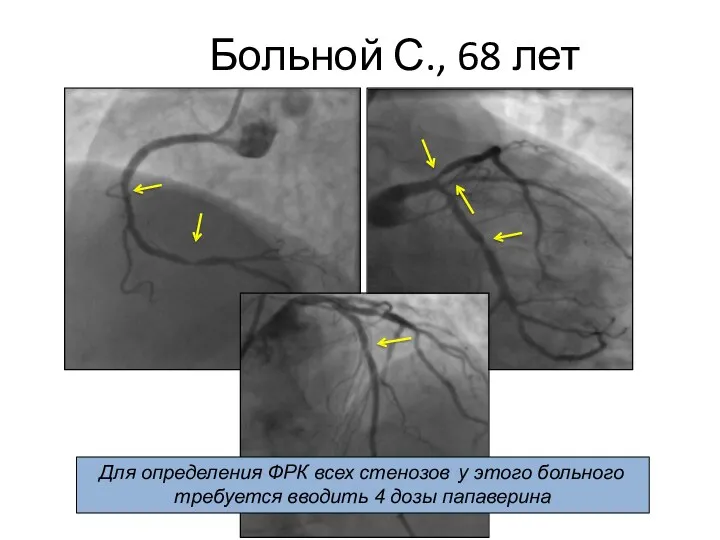 Больной С., 68 лет Для определения ФРК всех стенозов у