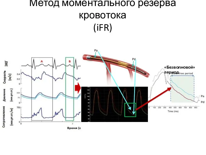 Метод моментального резерва кровотока (iFR) «Безволновой» период