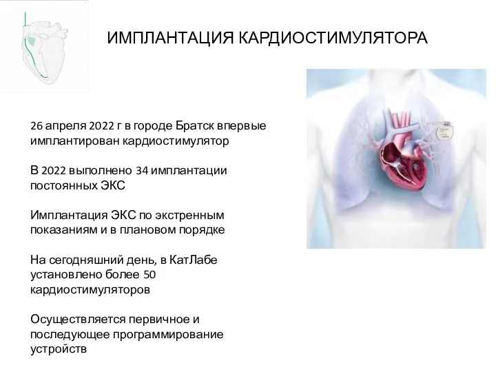 ИМПЛАНТАЦИЯ КАРДИОСТИМУЛЯТОРА 26 апреля 2022 г в городе Братск впервые