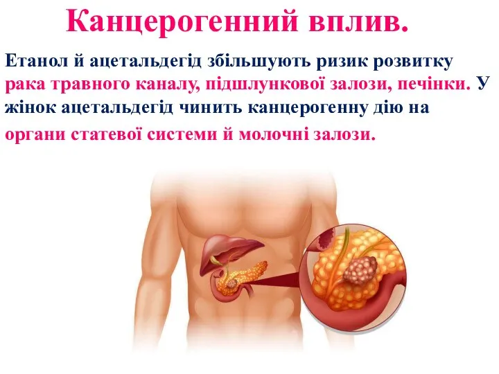 Канцерогенний вплив. Етанол й ацетальдегід збільшують ризик розвитку рака травного