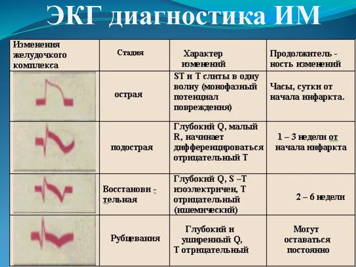 ЭКГ диагностика ИМ