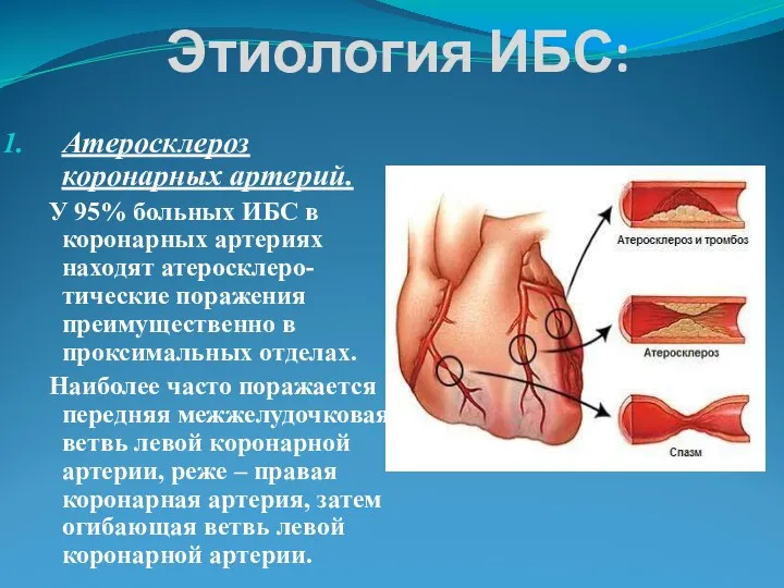 Этиология ИБС: Атеросклероз коронарных артерий. У 95% больных ИБС в