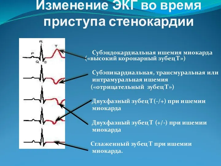 Изменение ЭКГ во время приступа стенокардии Субэндокардиальная ишемия миокарда («высокий