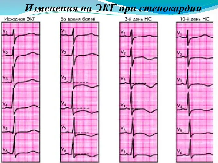 Изменения на ЭКГ при стенокардии