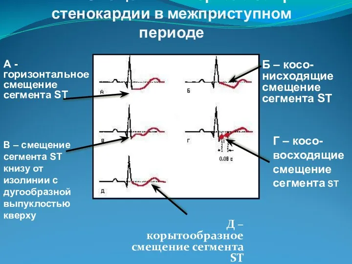 Типы смещения интервала ST при стенокардии в межприступном периоде Д