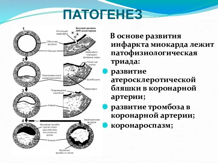 ПАТОГЕНЕЗ В основе развития инфаркта миокарда лежит патофизиологическая триада: развитие