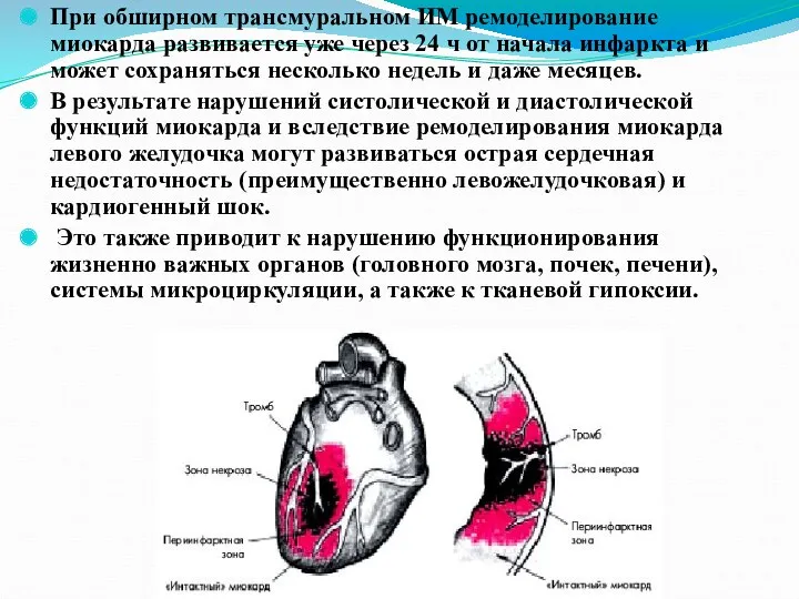 При обширном трансмуральном ИМ ремоделирование миокарда развивается уже через 24