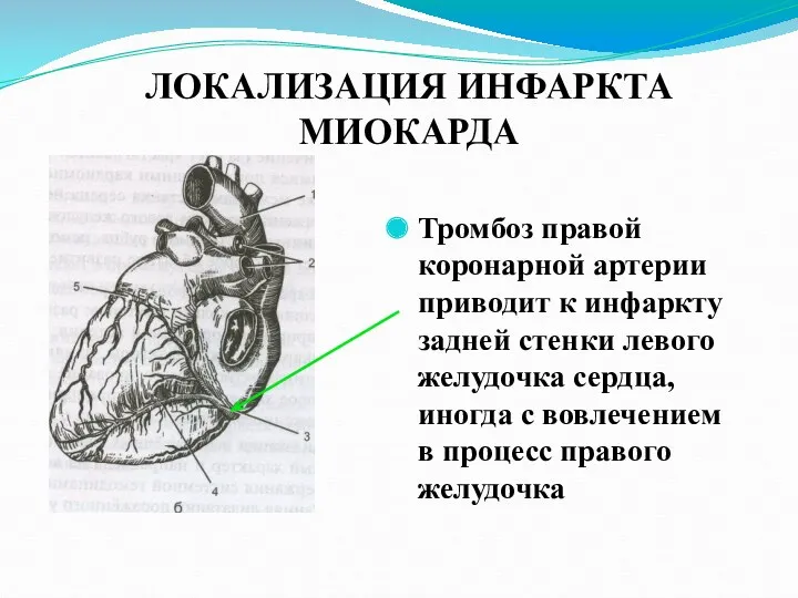 ЛОКАЛИЗАЦИЯ ИНФАРКТА МИОКАРДА Тромбоз правой коронарной артерии приводит к инфаркту