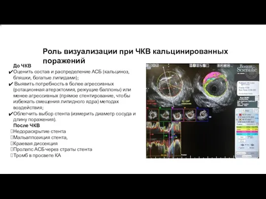 Роль визуализации при ЧКВ кальцинированных поражений До ЧКВ Оценить состав