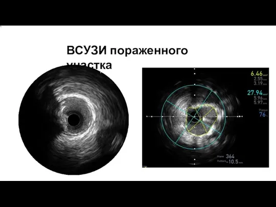 ВСУЗИ пораженного участка