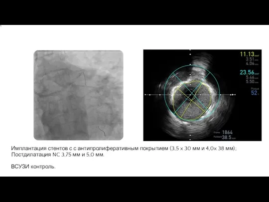 Имплантация стентов с с антипролиферативным покрытием (3,5 x 30 мм