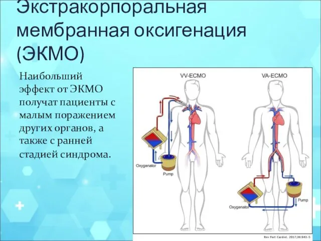 Экстракорпоральная мембранная оксигенация (ЭКМО) Наибольший эффект от ЭКМО получат пациенты