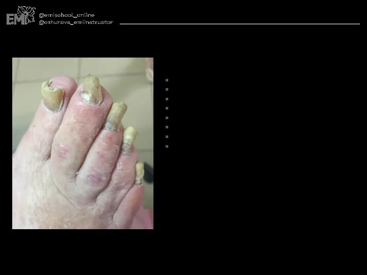 Причины возникновения: генетическая предрасположенность травмы псориаз ногтей нарушение процесса кератинизации ревматизм варикоз грибок на фоне старости