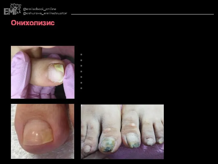 Онихолизис Нарушение связи ногтевой пластины с мягкими тканями ногтевого ложа.