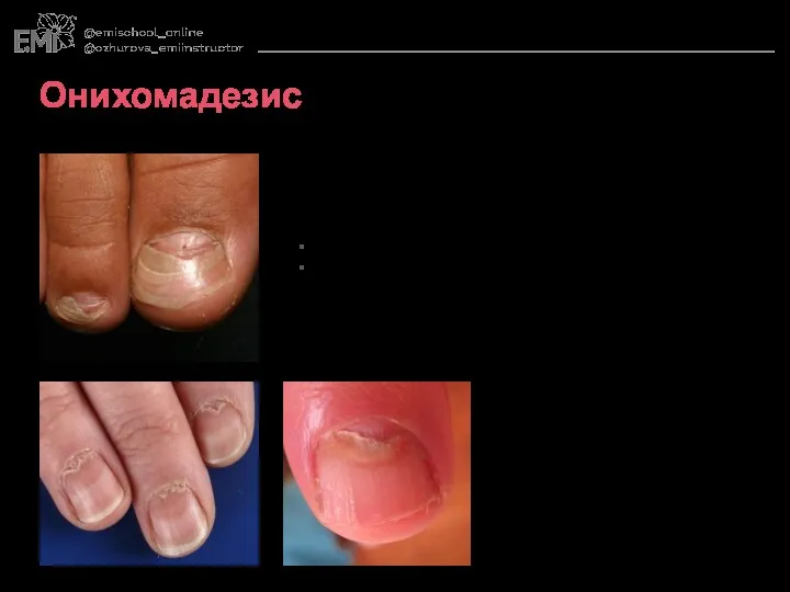 Причины: Нарушение кровообращения Патологии матрикса Онихомадезис Облысение ногтевой пластины.