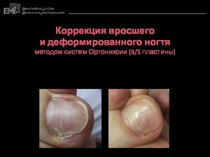 Коррекция вросшего и деформированного ногтя методом систем Ортониксии (B/S пластины)