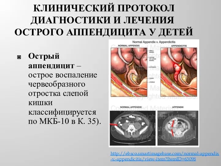 КЛИНИЧЕСКИЙ ПРОТОКОЛ ДИАГНОСТИКИ И ЛЕЧЕНИЯ ОСТРОГО АППЕНДИЦИТА У ДЕТЕЙ Острый