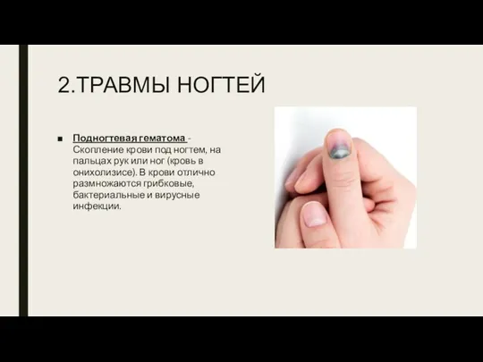 2.ТРАВМЫ НОГТЕЙ Подногтевая гематома - Скопление крови под ногтем, на