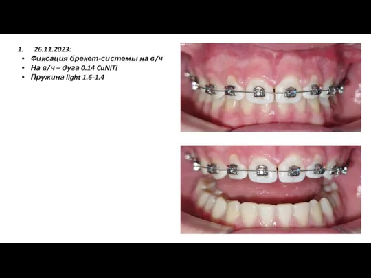 26.11.2023: Фиксация брекет-системы на в/ч На в/ч – дуга 0.14 CuNiTi Пружина light 1.6-1.4