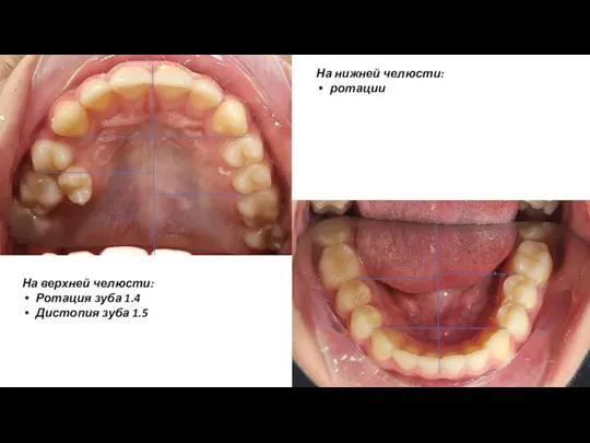 На нижней челюсти: ротации На верхней челюсти: Ротация зуба 1.4 Дистопия зуба 1.5