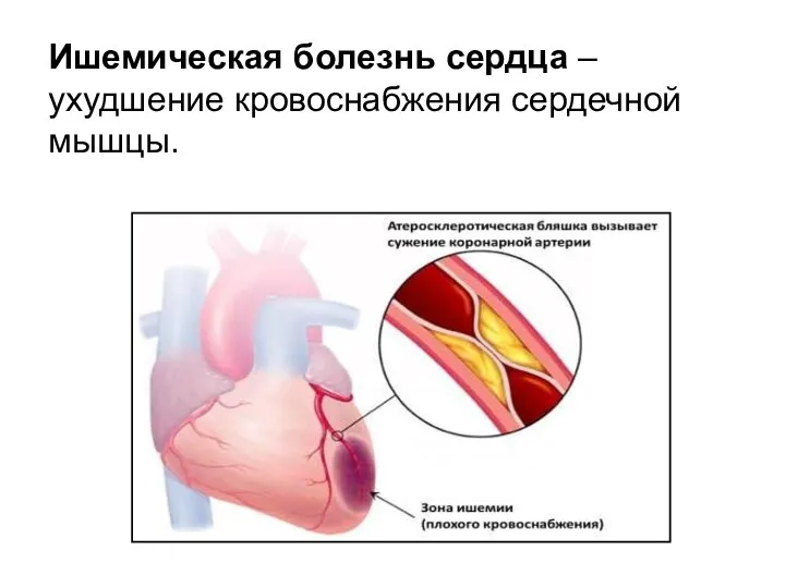 Ишемическая болезнь сердца – ухудшение кровоснабжения сердечной мышцы.