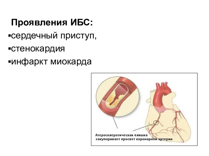 Проявления ИБС: сердечный приступ, стенокардия инфаркт миокарда