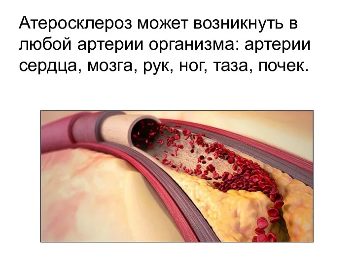 Атеросклероз может возникнуть в любой артерии организма: артерии сердца, мозга, рук, ног, таза, почек.