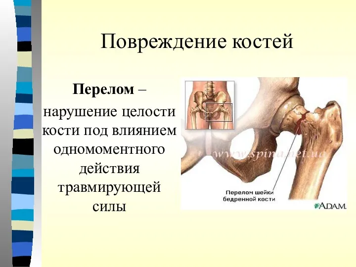 Повреждение костей Перелом – нарушение целости кости под влиянием одномоментного действия травмирующей силы