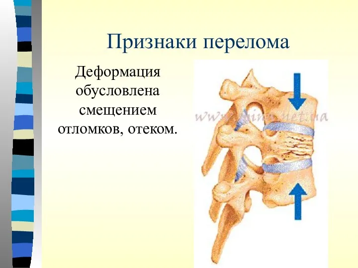 Признаки перелома Деформация обусловлена смещением отломков, отеком.