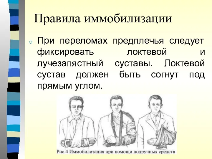 Правила иммобилизации При переломах предплечья следует фиксировать локтевой и лучезапястный