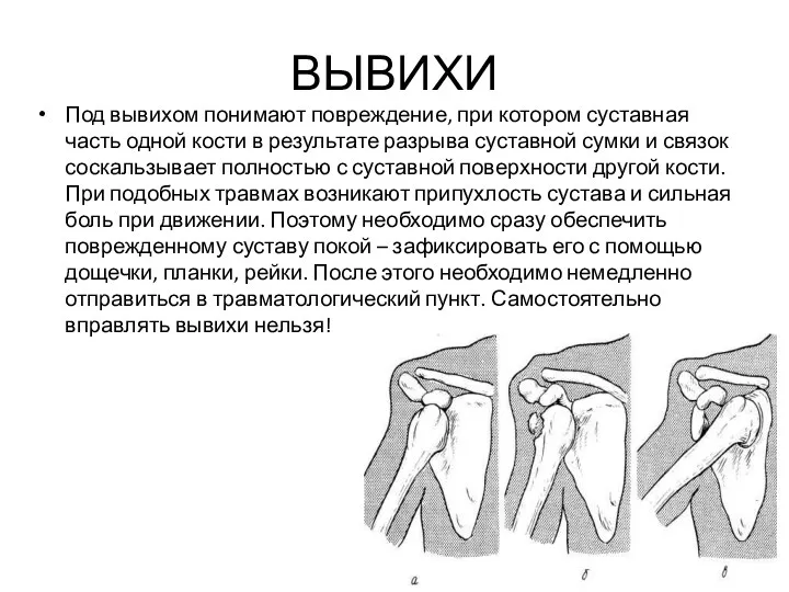 ВЫВИХИ Под вывихом понимают повреждение, при котором суставная часть одной