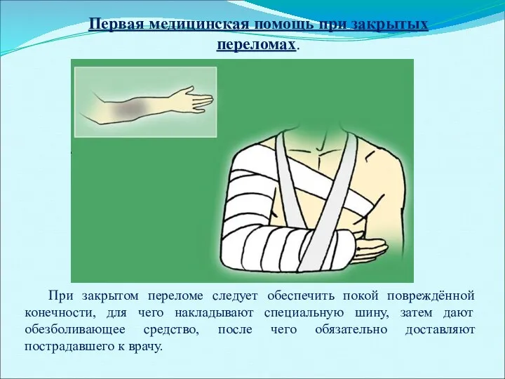 Первая медицинская помощь при закрытых переломах. При закрытом переломе следует