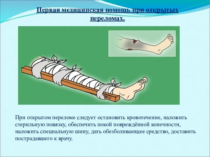 Первая медицинская помощь при открытых переломах. При открытом переломе следует