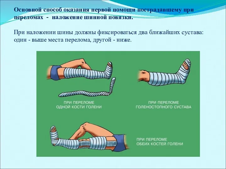 Основной способ оказания первой помощи пострадавшему при переломах - наложение