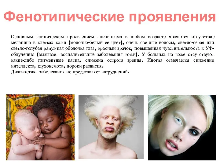 Основным клиническим проявлением альбинизма в любом возрасте являются отсутствие меланина